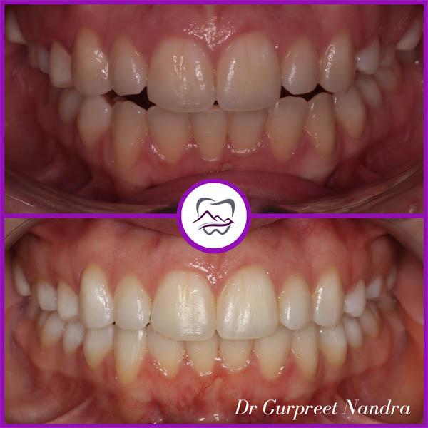 anterior-open-bite-before-and-after-1