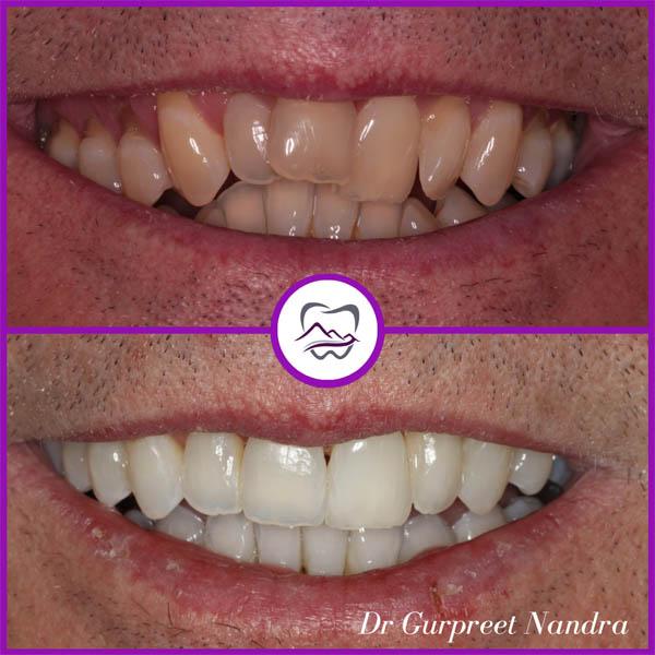 before-and-after-bonding-whitening-invisalign-1