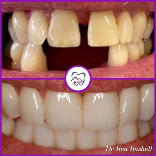 Crowns, Veneers & Bridges