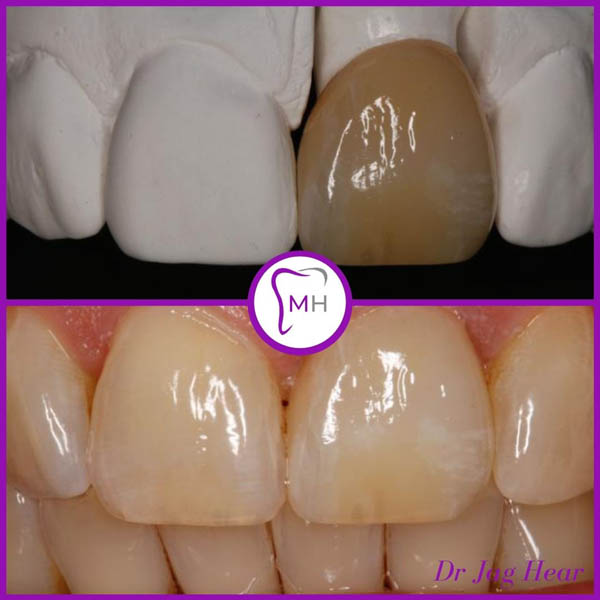 Dental Crowns