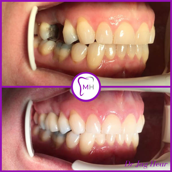 dental-implant-before-and-after-1-geo