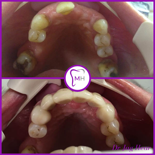 dental-implant-before-and-after-2-geo