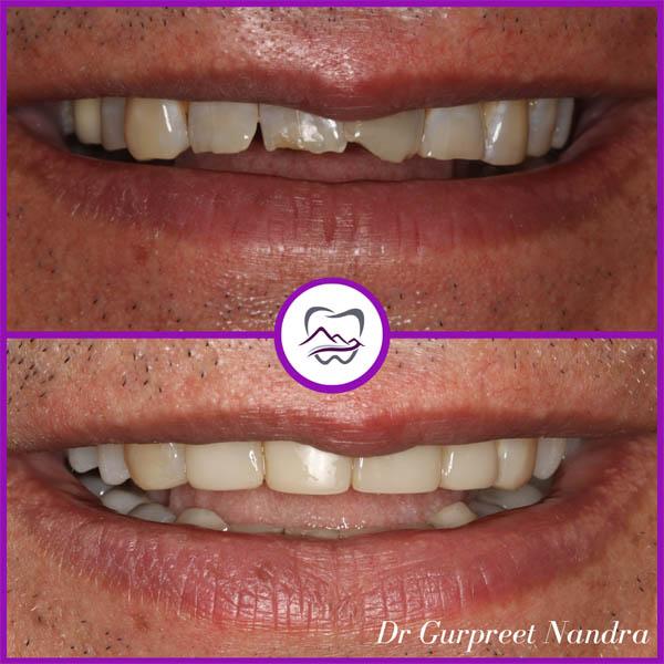 full-mouth-rehab-malvern-before-and-after-1