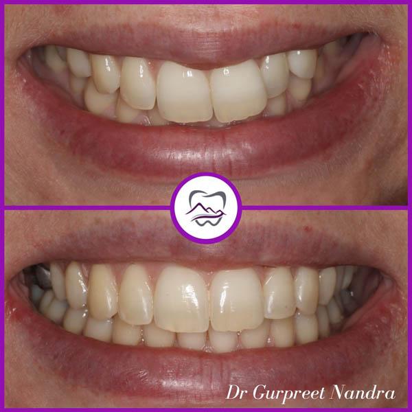 invisalign-before-and-after-7