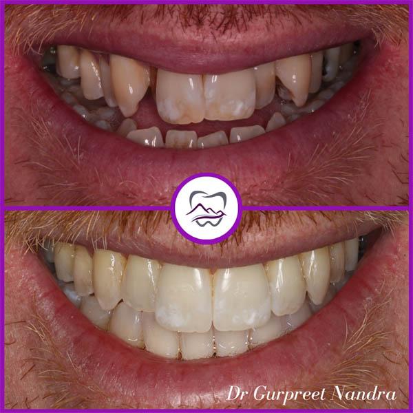 invisalign-before-and-after-malvern-51