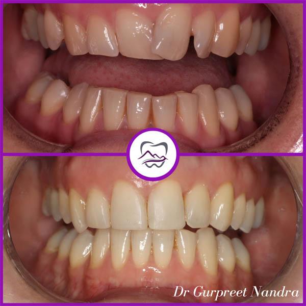 invisalign-bonding-whitening-before-and-after-1-malvern