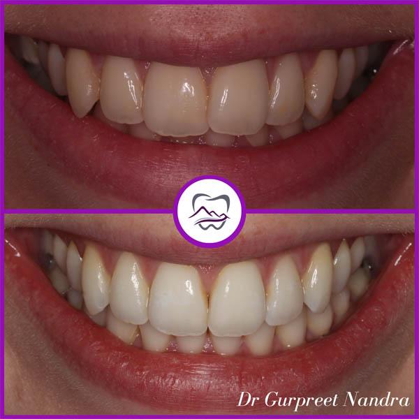 invisalign-whitening-1-before-and-after-malvern