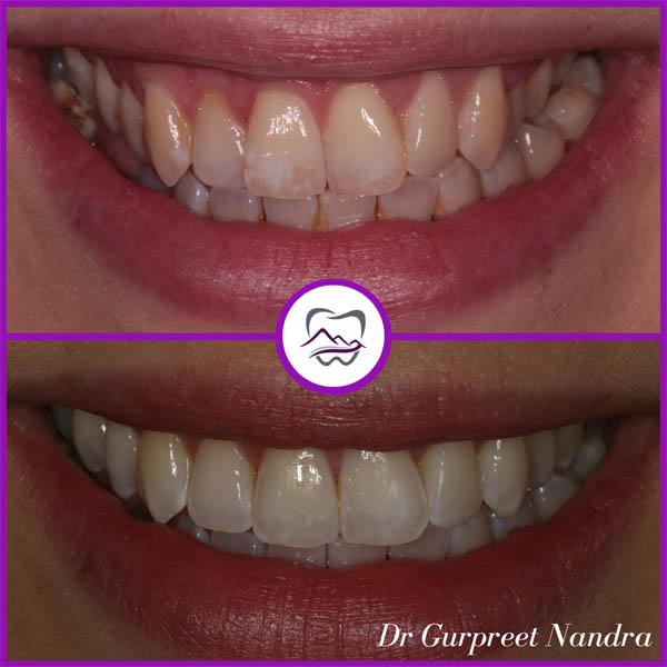 invisalign-whitening-before-and-after-1(1)