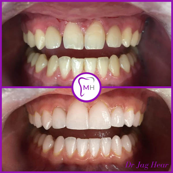 Porcelain Veneers