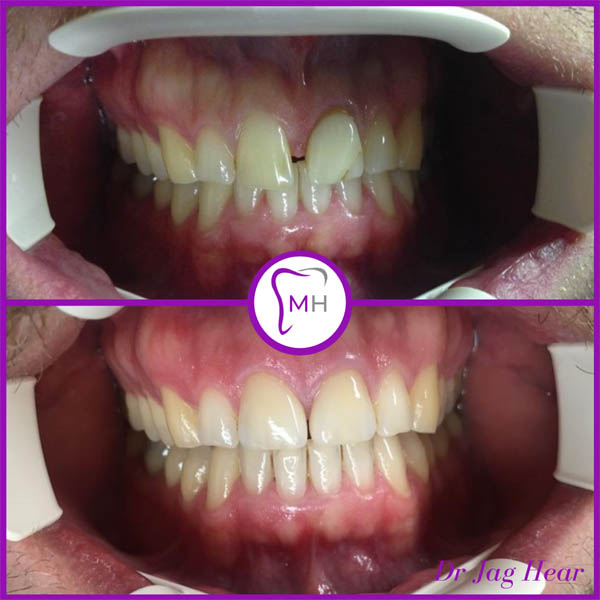 Porcelain Veneers