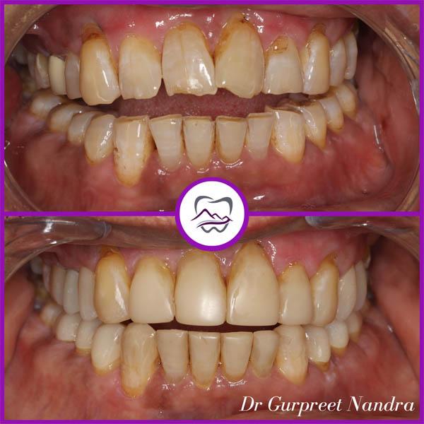 tooth-wear-before-and-after-1-malvern