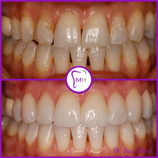 veneers-smile-make-over-before-and-after-1