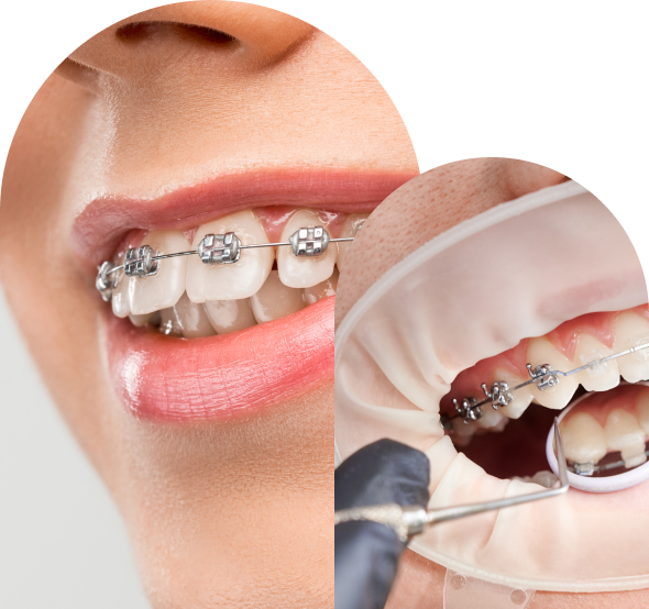 Braces in Malvern dentist Malvern